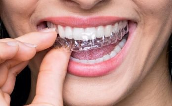 Invisalign Dubai